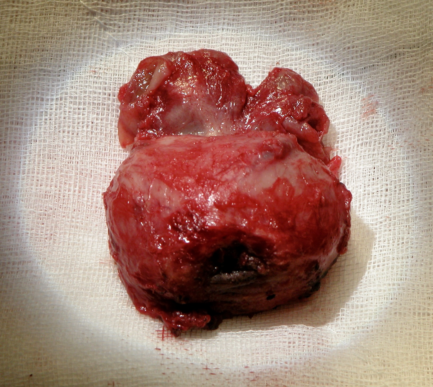 Removed prostate specimen