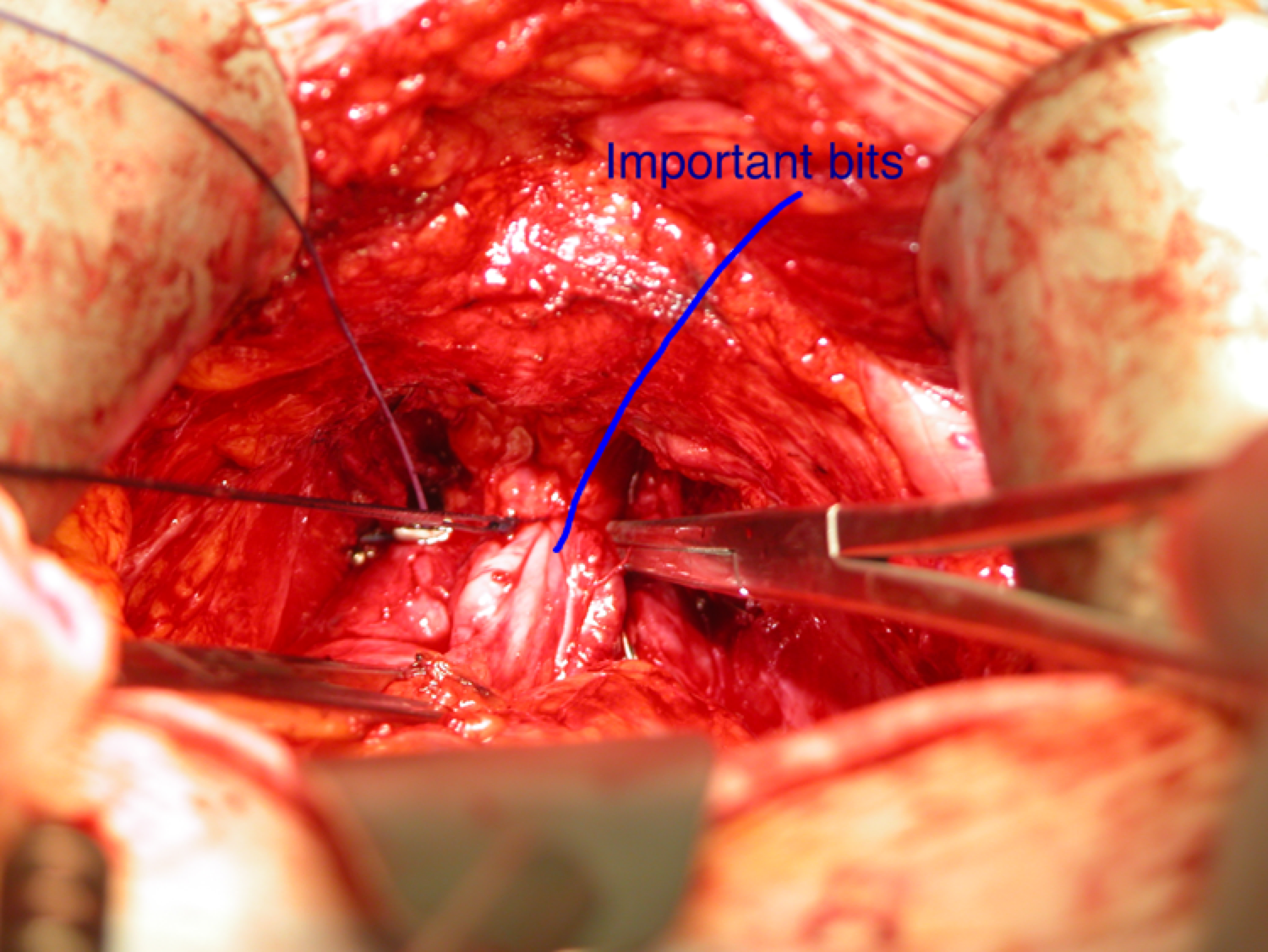 Prostatectomy operative field